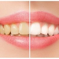 7 ways to remove tartar and plaque from teeth at home