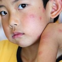 is it possible for bed bugs to bite your face