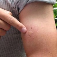 what can i put on my body to prevent bed bug bites